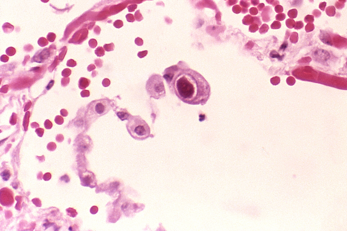 Photo: Cytomegalovirus (CMV) infection of a lung