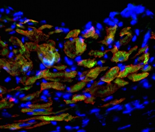Induced cardiac progenitor cells (iCPCs) injected into hearts of mice with experimentally induced heart attacks generate new heart muscle. Newly developed heart muscle cells are shown by overlapping red (heart muscle protein) and green (iCPC protein) labeling, and cell nuclei are shown in blue. 