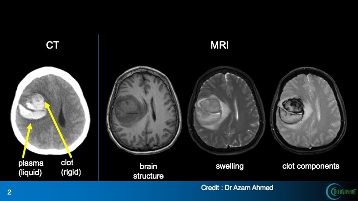 MR Guidance: Next frontier in hemorrhagic stroke