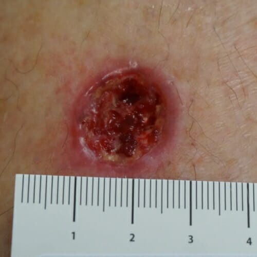 Photo: Closeup of ulcer
