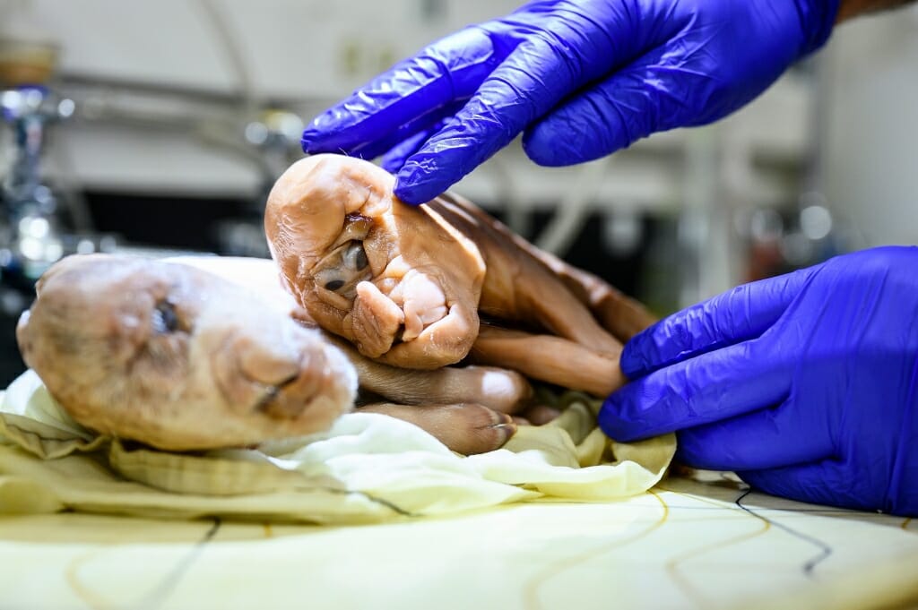 cyclopia holoprosencephaly