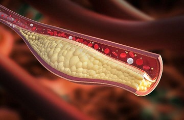 Cross-section diagram of cholesterol with blood cells flowing around it in an artery