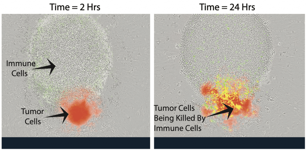 immune cells, which look like small, clear circles, next to a small red sphere of neuroblastoma (cancer) cells