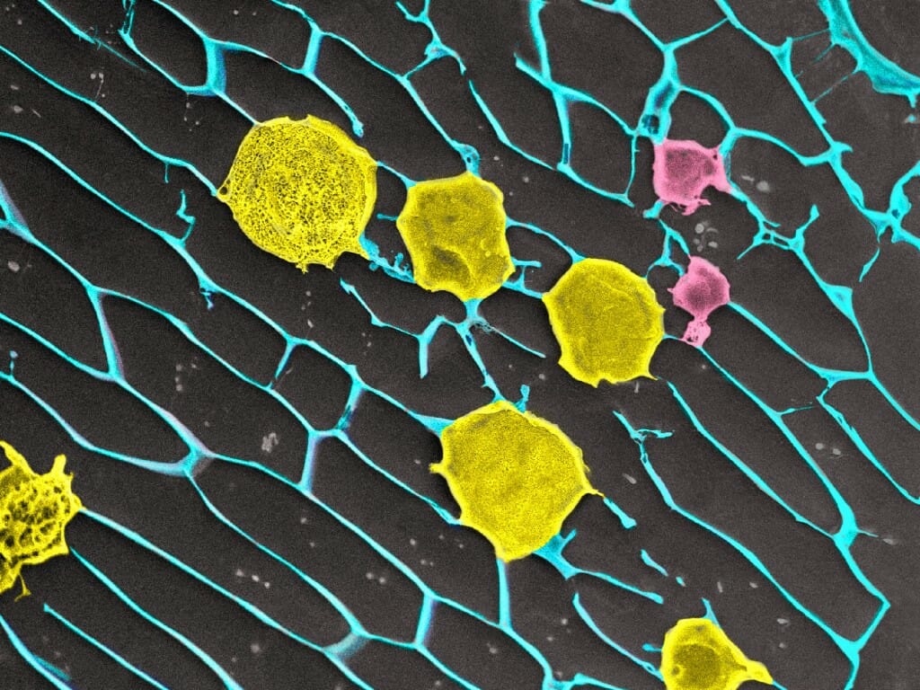 Gel loaded with cancer-fighting cells keeps tumors in check after ...