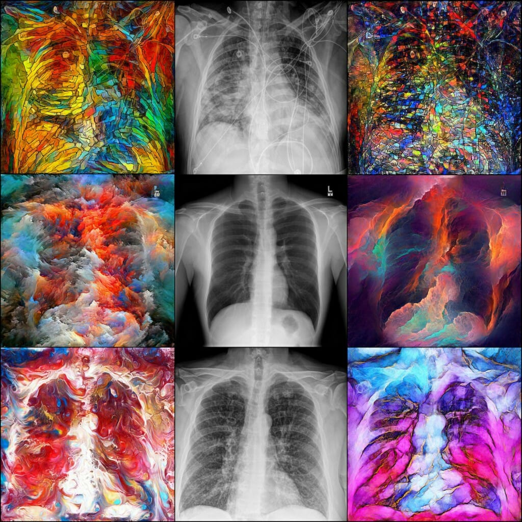 These stylistically different takes on chest X-rays were created by generative adversarial networks, computing networks designed to “learn” like the human brain learns. While these particular works of art are more beautiful than useful in radiology, GANs are used in medical imaging to enhance, classify and reconstruct information and understand the differences between X-rays of a COVID case (top), pneumonia (bottom) and healthy lungs (center).
Dalton Griner,
graduate student, Medical Physics;
Xin Tie,
graduate student, Medical Physics
 chest x-rays and PyTorch deep learning framework