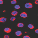 On a black background, lymphoma cells show up in a red and blue polkadot pattern.