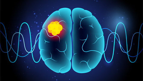 Abstract illustration of a brain with with a yellow concentration portraying a tumor.