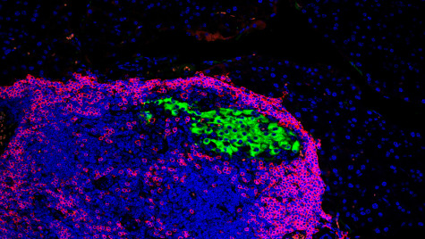 Immunofluorescence images of pancreatic cells and immune cells in contrasting colors.