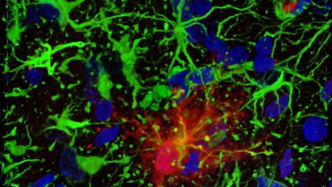 Microscopic image of brain cells showing signs of glial fibrillary acidic protein.
